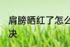 肩膀晒红了怎么办 肩膀晒红了如何解决