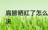 肩膀晒红了怎么办 肩膀晒红了如何解决